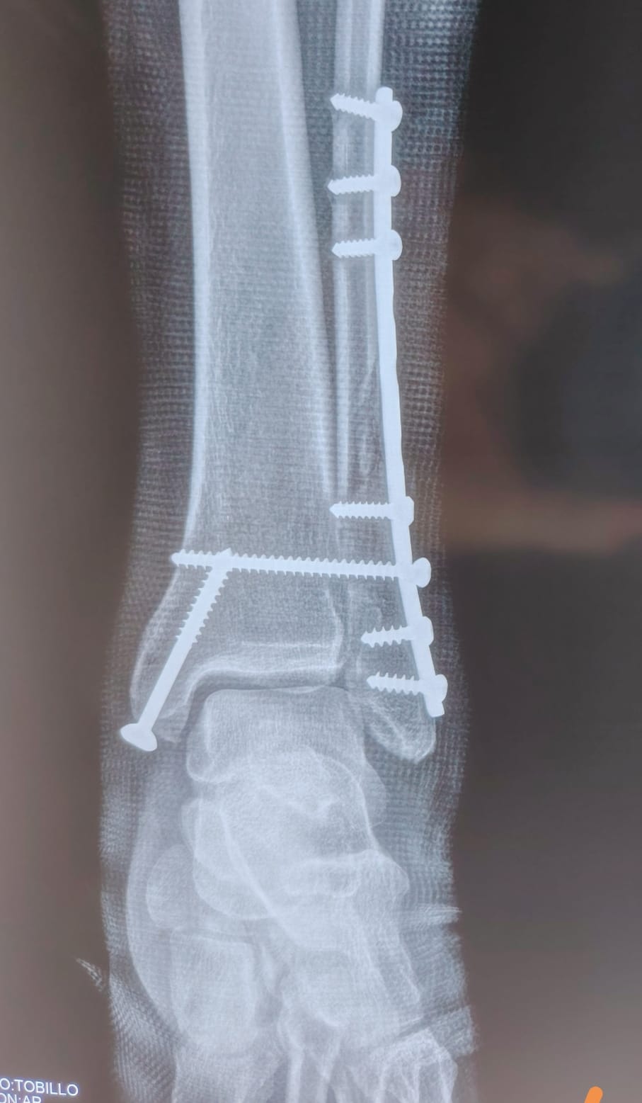 Imagen de fractura de tobillo post - operada
