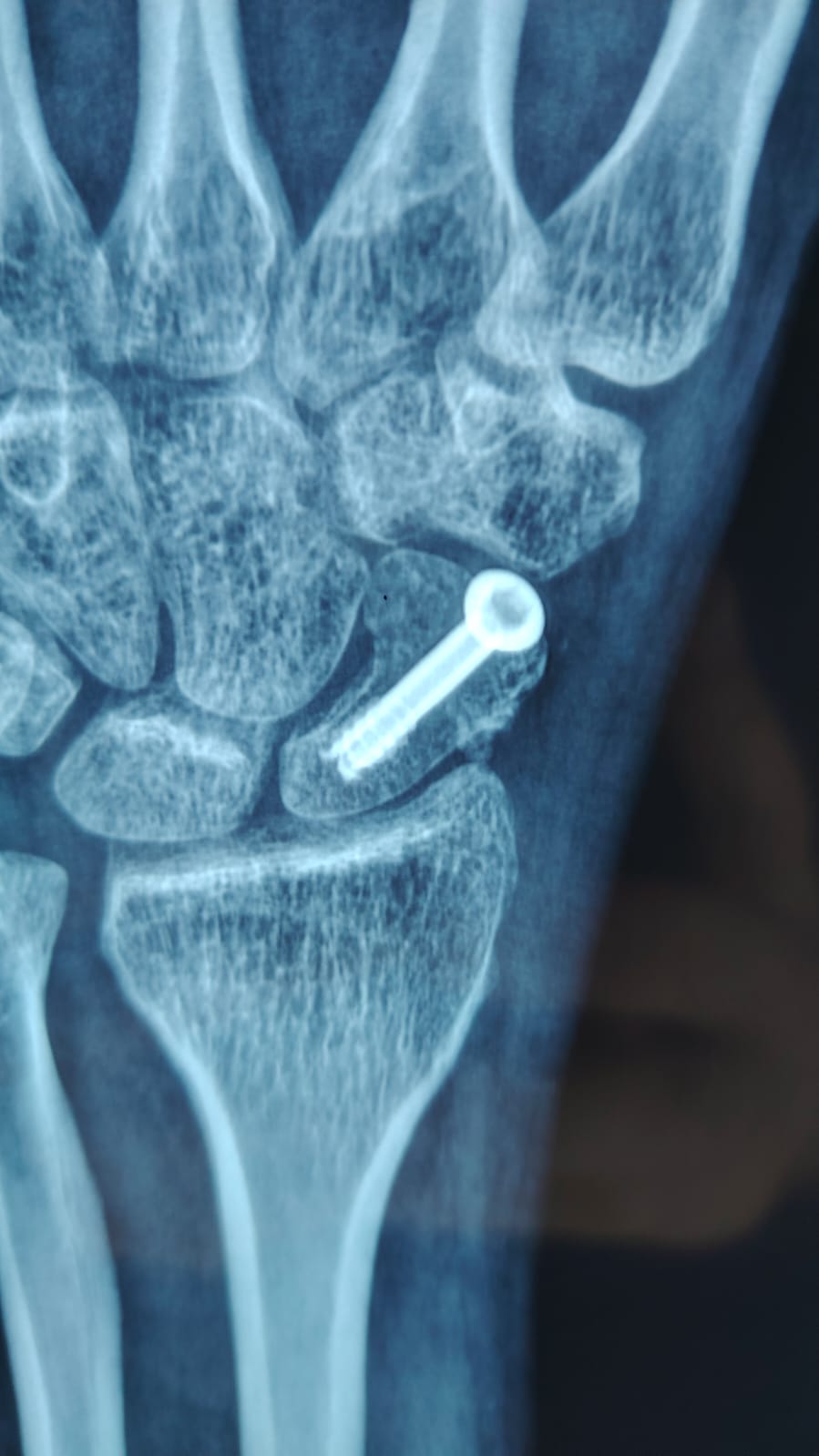 Imagen de fractura de hueso escafoides de la  mano manejada con Tornillo Canulado