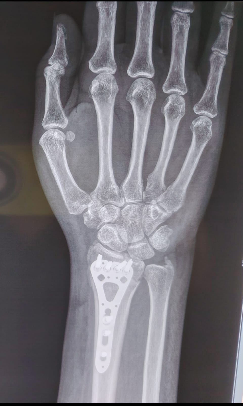 Fractura de muñeca manejada con placa de última generación.