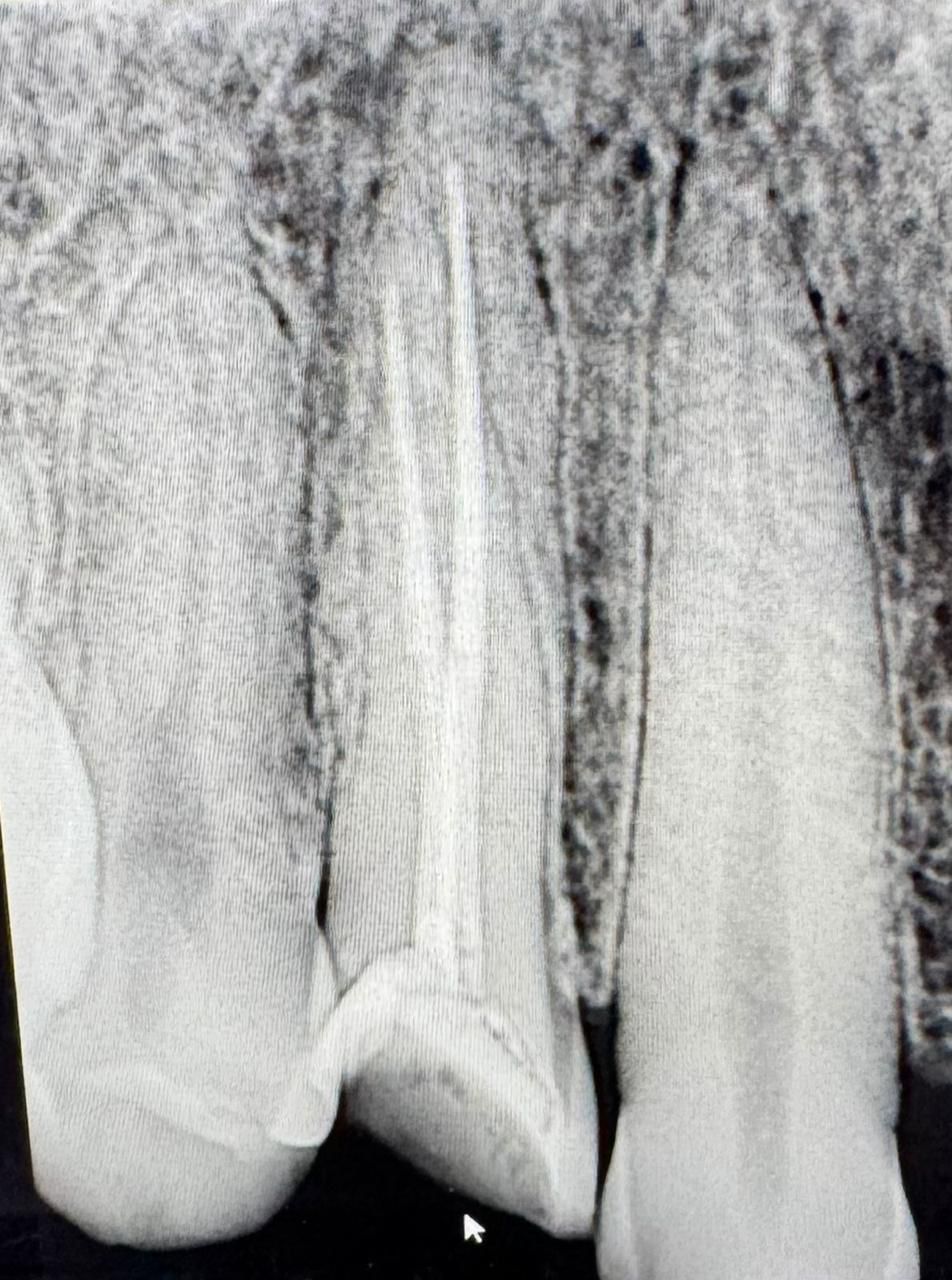 Endodoncia Despues.jpeg