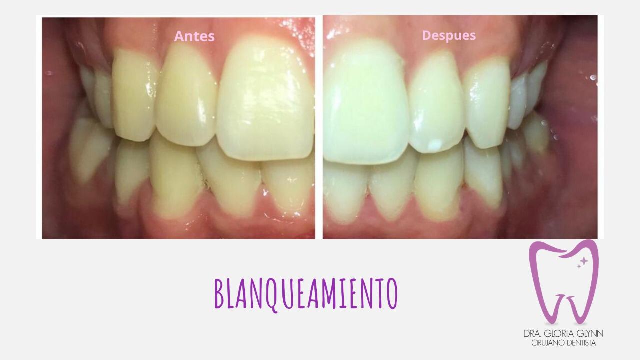 Blanqueamiento Dental (Antes y Después) 