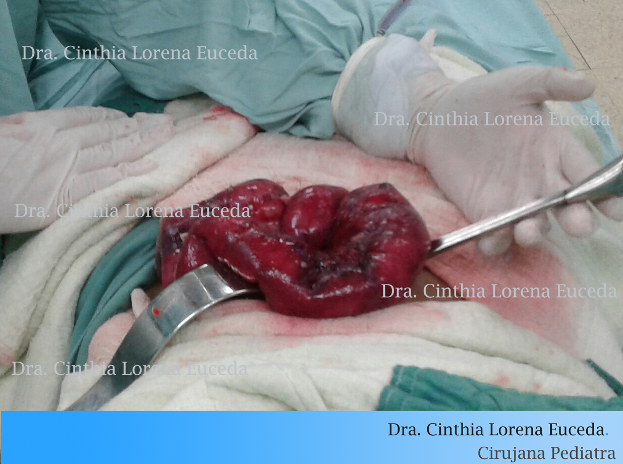 Apéndices complicadas con peritonitis que he operado