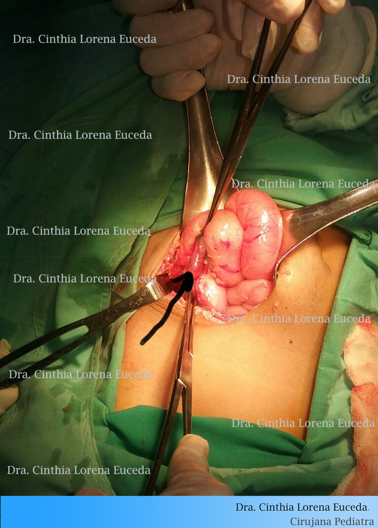 Apéndices complicadas con peritonitis que he operado