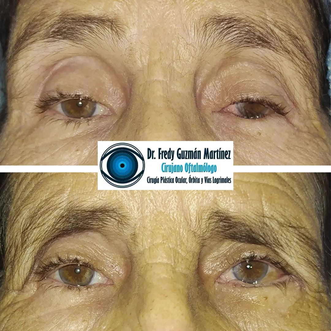 Corrección de Entropión párpado inferior ojo izquierdo