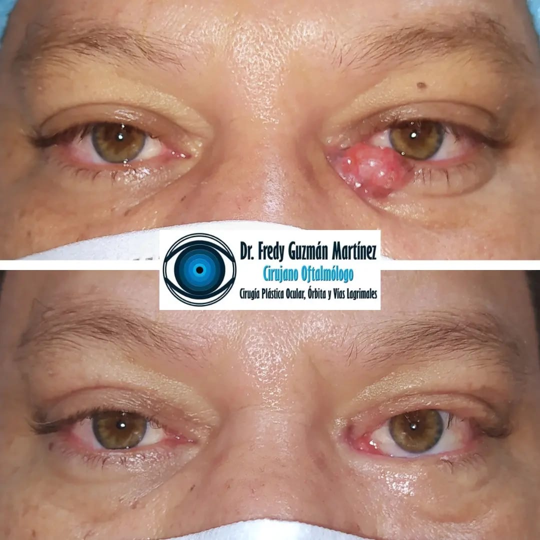 Carcinoma Basocelular en párpado inferior de ojo izquierdo, involucra punto y canalículo lagrimal inferior.