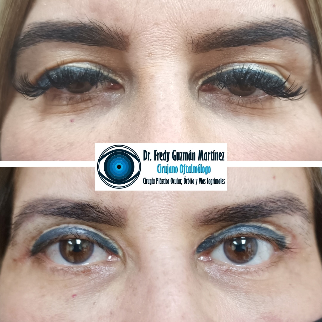 Blefaroplastía superior más corrección de ptosis palpebral de ambos ojos.