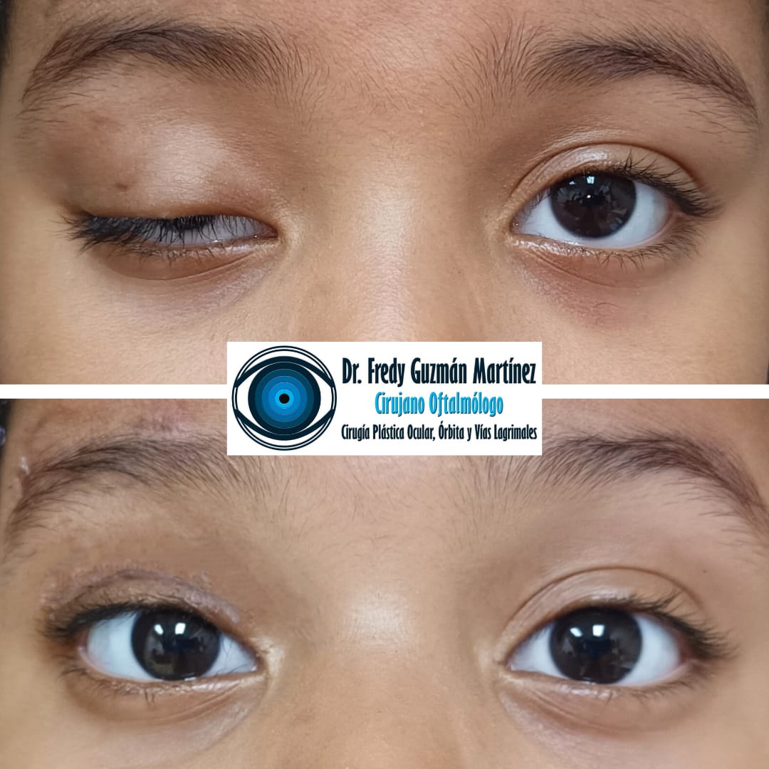 Corrección de ptosis palpebral congénita de ojo derecho