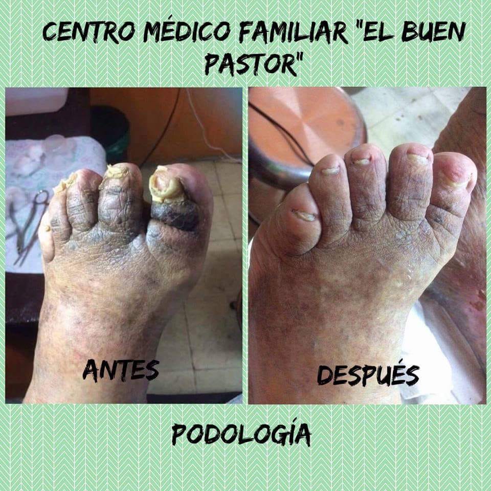 Padologia " Antes y Después"