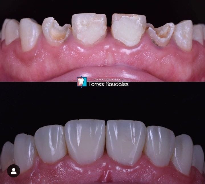 Reconstrucción dental