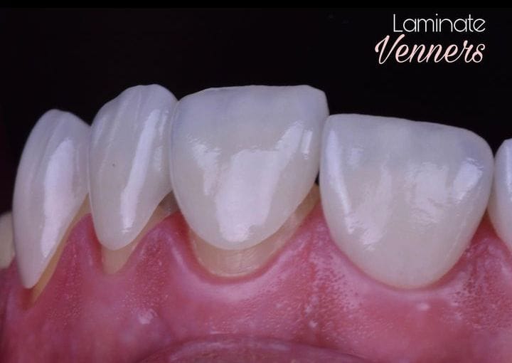 Laminate Venners 