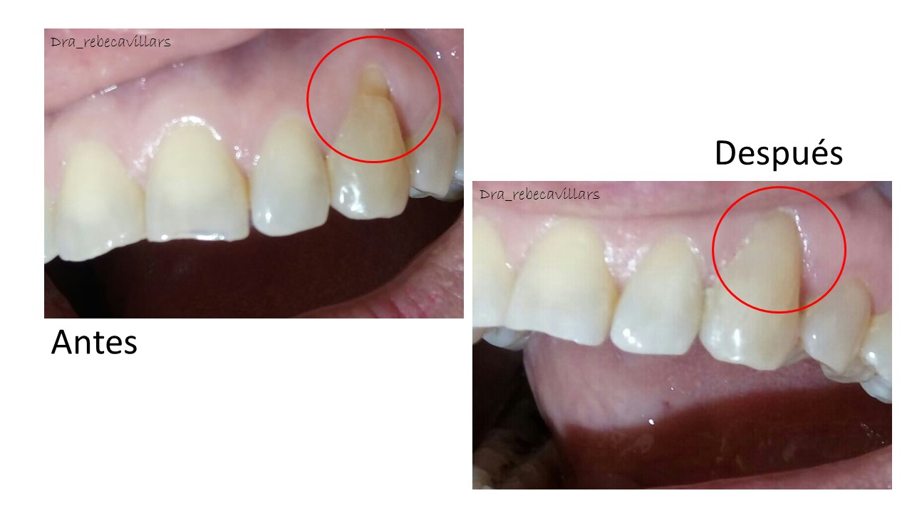 Desgaste de canino por causa del cepillado, trabajamos con resina de alta estética.