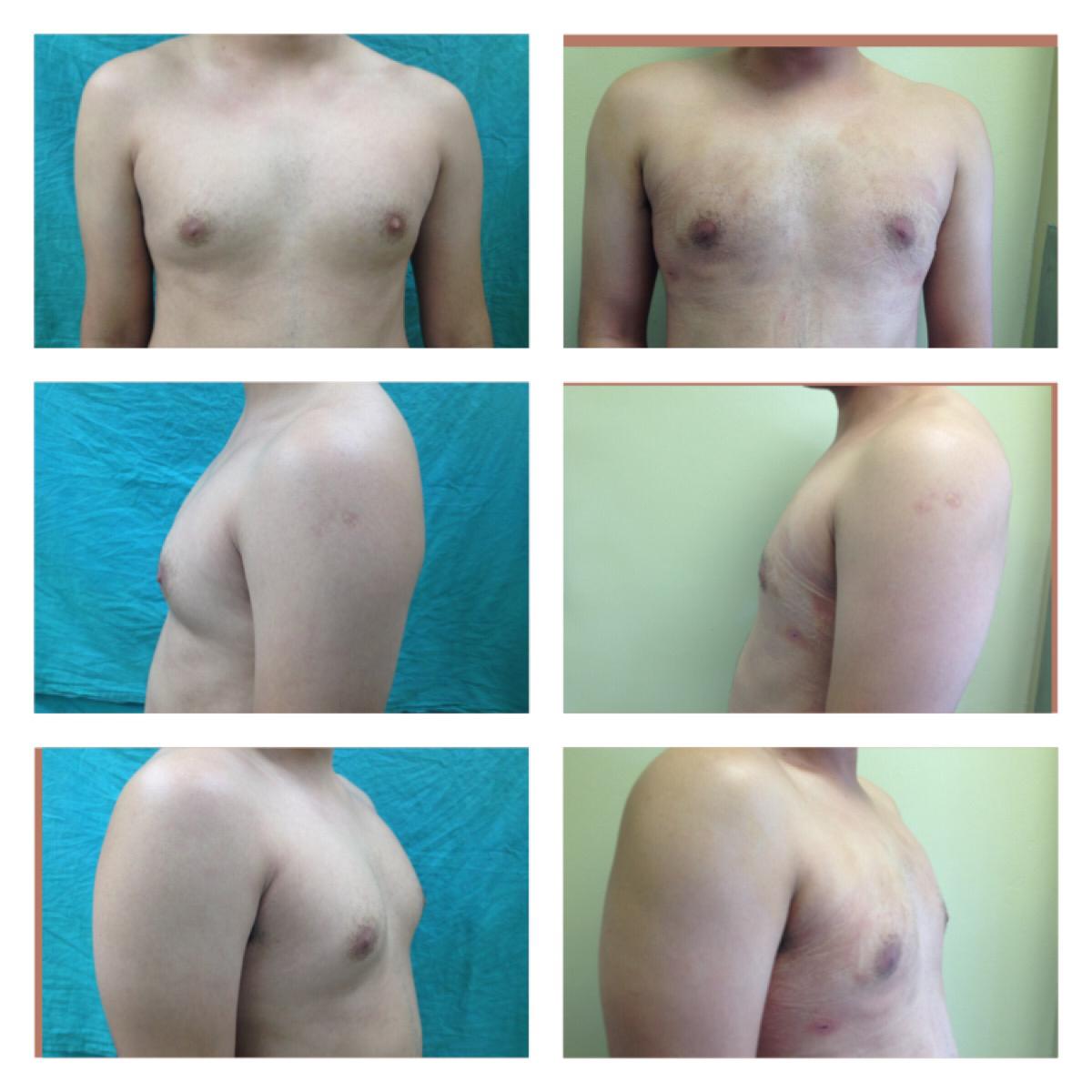 Ginecomastia con liposuccion 