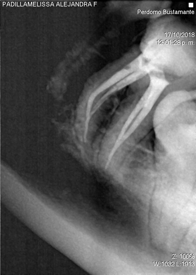 Endodoncia Finalizada Cuatro Conductos