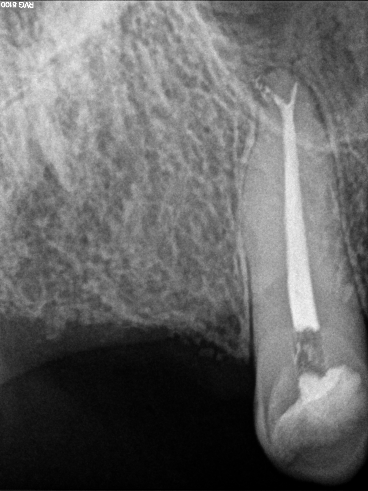 Endodoncia Finalizada Canino Superior