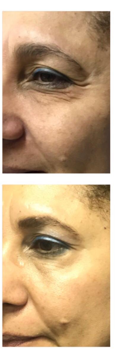 Tratamiento NO quirúrgico de las patas de gallo- Toxina Dysport una excelente opción.