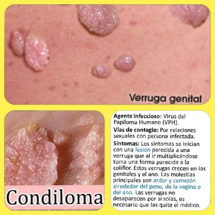 Eliminación de verrugas a un excelente precio, resultados garantizados! 