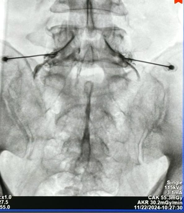 Bloqueo transforaminal de L5 bilateral por dolor radicular tipo corriente severo irradiado a ambos miembros inferiores