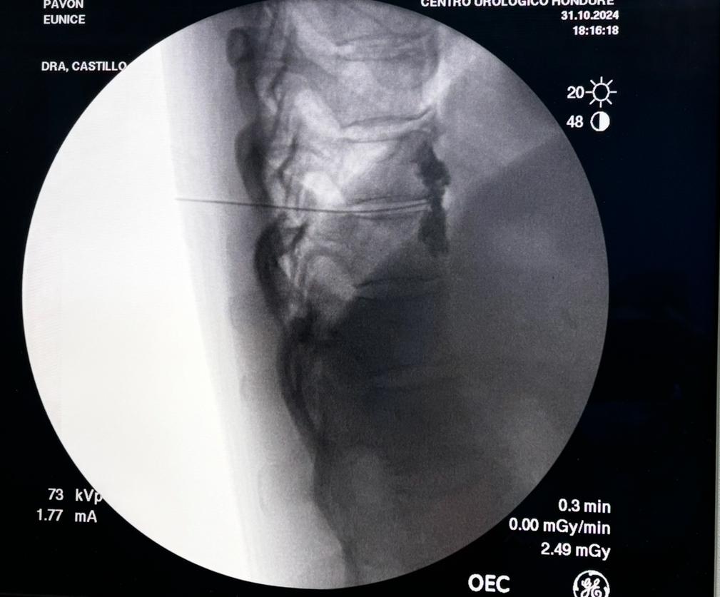 Inhibición plexo Esplacnico con Neurolisis química  para tratar dolor en cancer de páncreas avanzado