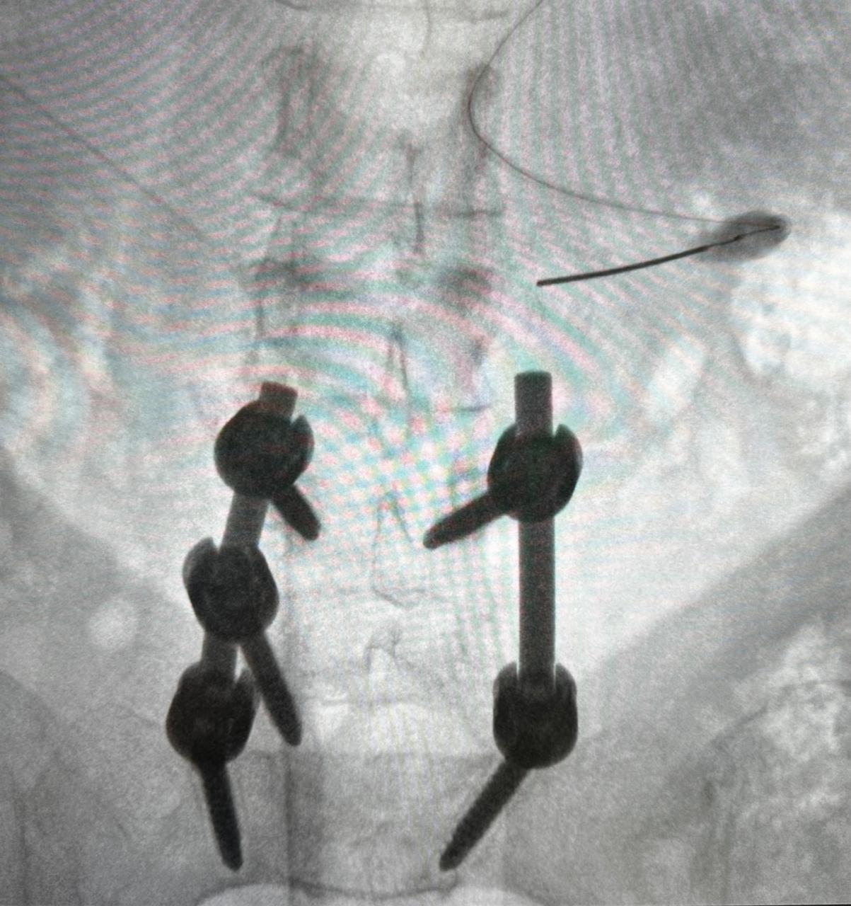 Tratamiento con diferentes técnicas en síndrome de espalda fallida ( post operatorio en columna )